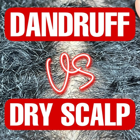 Difference Between Dandruff vs Dry Scalp: What Are the Causes and Treatments
